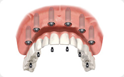 prothese maxillaire sur implants